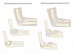 Medizinische Grafik Ellenbogen